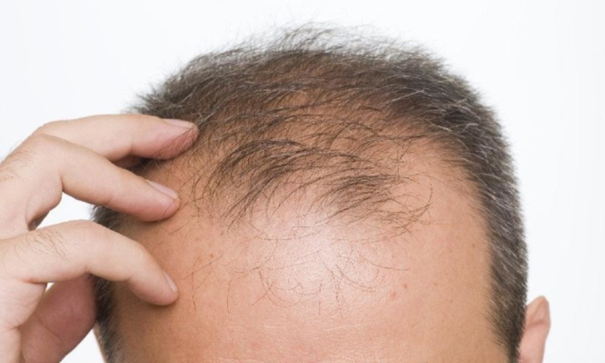 Αλωπεκία: Όλα τα είδη και οι τρόποι θεραπείας