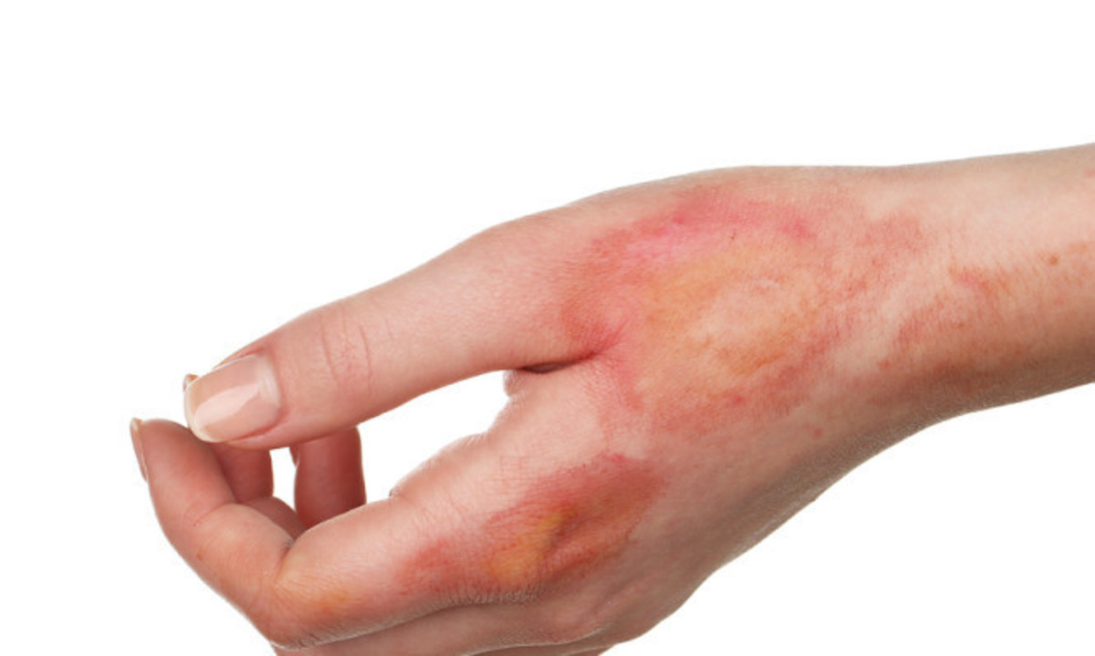 Έγκαυμα: Βήμα-βήμα η σωστή αντιμετώπιση για όλες τις περιπτώσεις