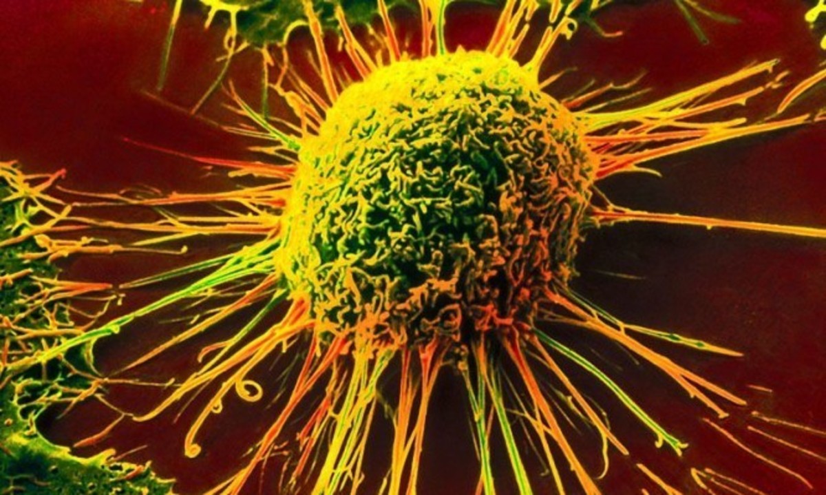 Και όμως: Ο καρκίνος μπορεί να αποφευχθεί τις περισσότερες φορές! Τι βρήκαν οι επιστήμονες