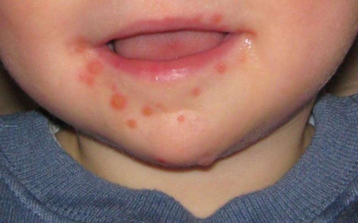 Ιός κοξάκι: Μάθετε μέσα από εικόνες πώς να τον αναγνωρίσετε