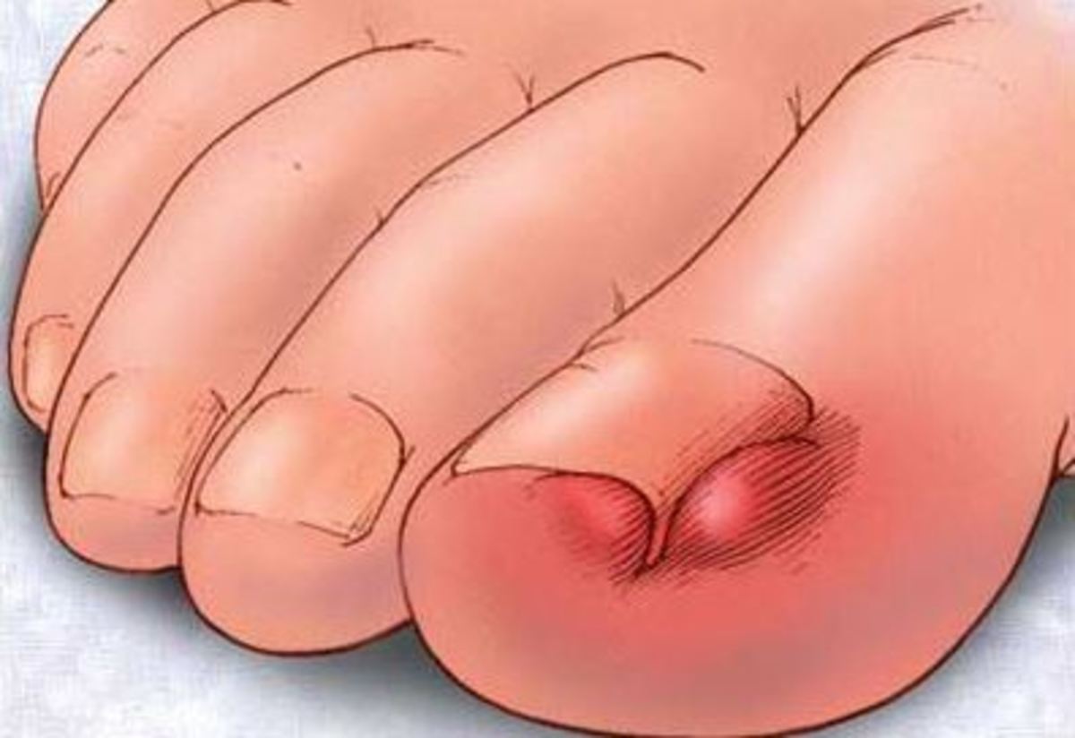 Νύχι που μπαίνει στο δέρμα: Τι μπορείτε να κάνετε στο σπίτι