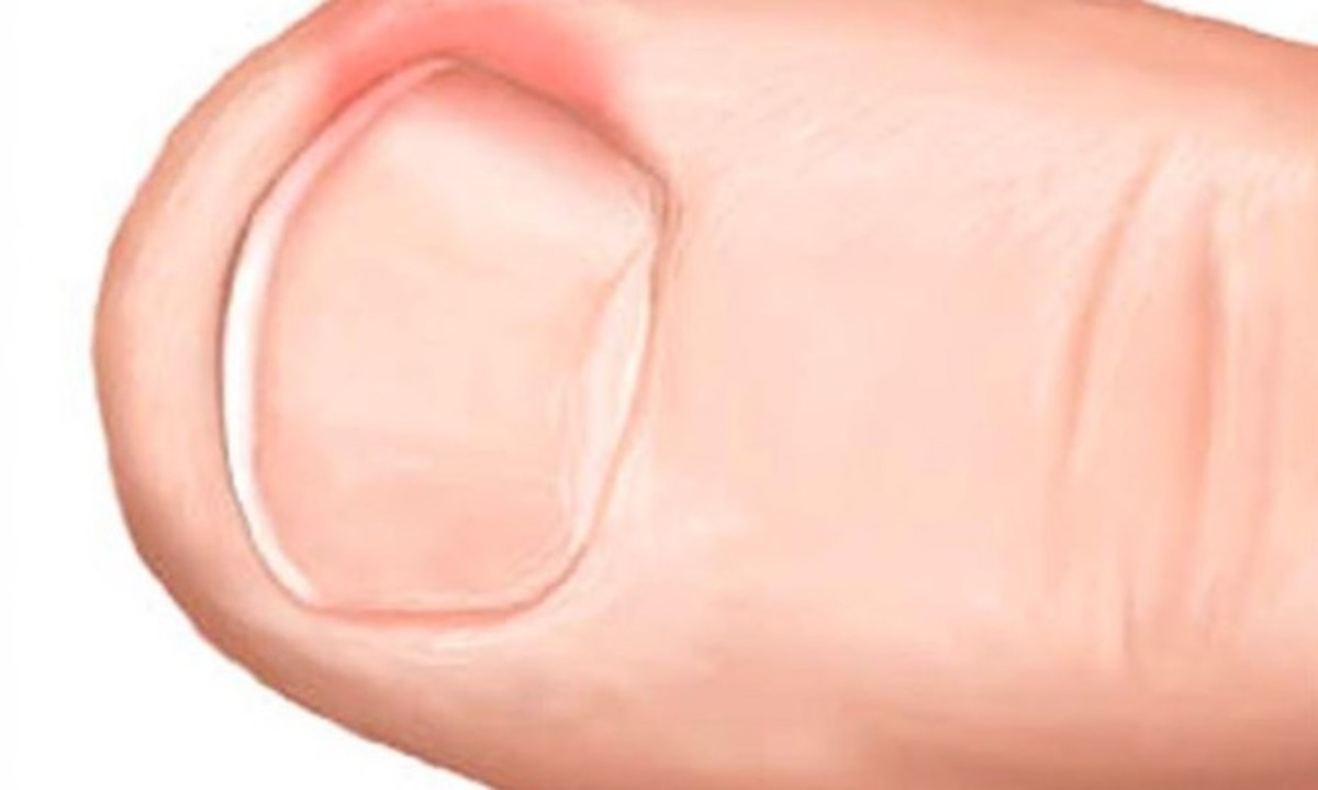 Ονυχοκρύπτωση: Τι να κάνετε όταν το νύχι μπαίνει μέσα στο δέρμα