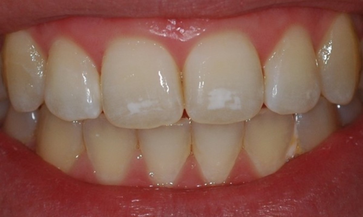 Λευκά σημάδια στα δόντια: Πού οφείλονται – Τι πρέπει να κάνετε