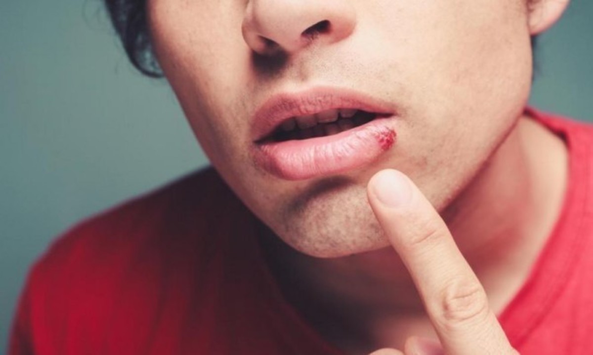 Επιχείλιος έρπης: Προσοχή στον ήλιο – Τι πρέπει να ξέρετε