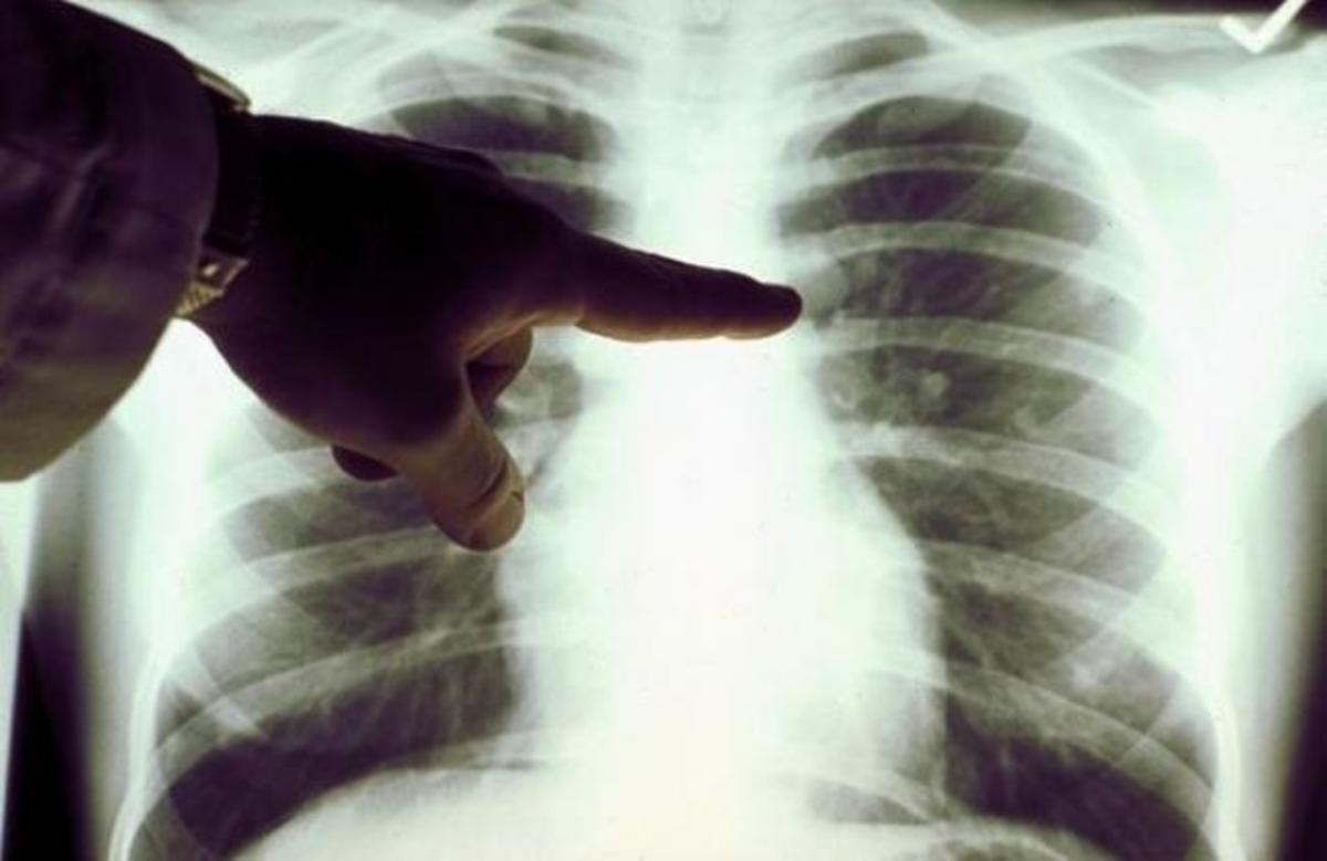 SOS: Τα σημάδια που δείχνουν συσσώρευση υγρού στον πνεύμονα