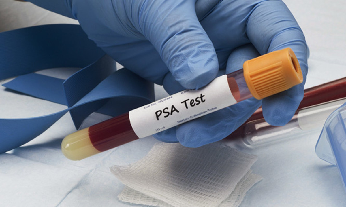 Προστάτης: Οι φυσιολογικές τιμές στην εξέταση – Πότε χτυπάει «καμπανάκι»