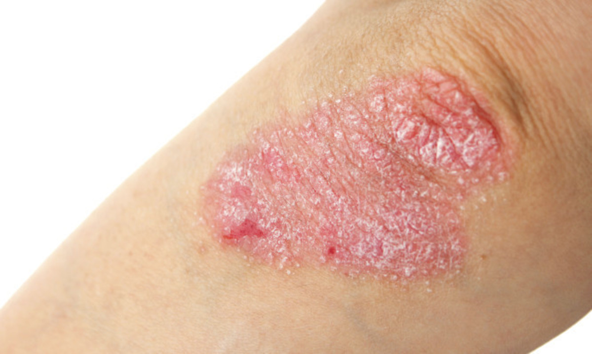 Ψώρα ή ψωρίαση; Πώς θα καταλάβετε τι έχετε – Οι διαφορές στα συμπτώματα