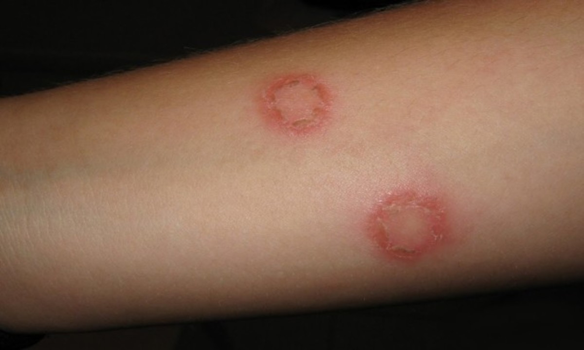 Τι σημαίνει αν δείτε τέτοια σημάδια οπουδήποτε στο σώμα σας (εικόνες)