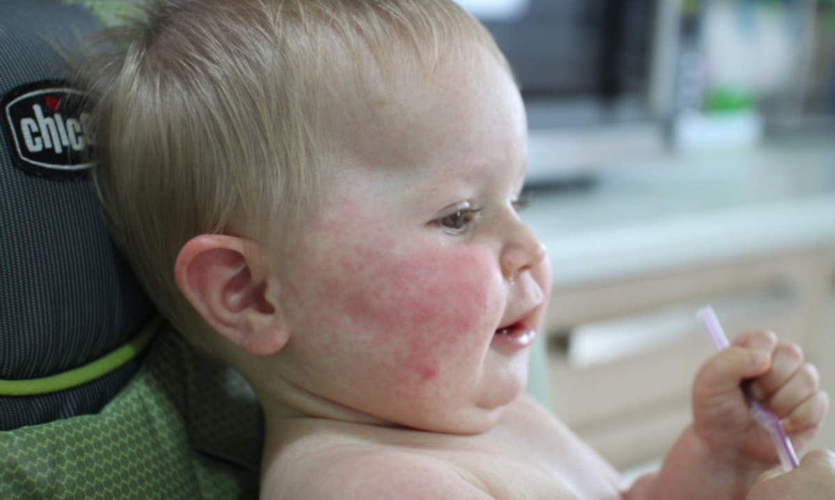 Παιδικές ασθένειες: Τι πρέπει να ξέρετε για το αιφνίδιο εξάνθημα