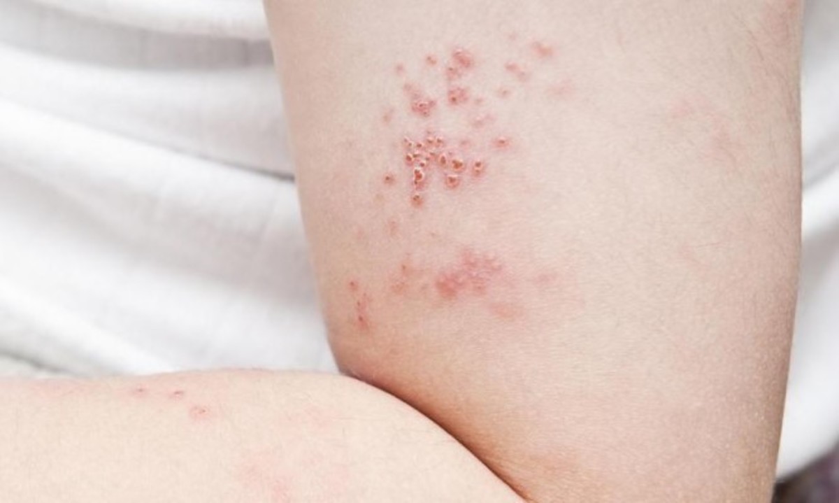 Έρπης ζωστήρ: Συμπτώματα και τι πρέπει να κάνετε