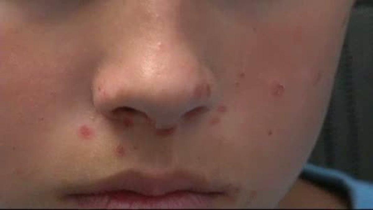 Ιός Κοξάκι: Πώς θα τον εντοπίσετε εγκαίρως στο παιδί