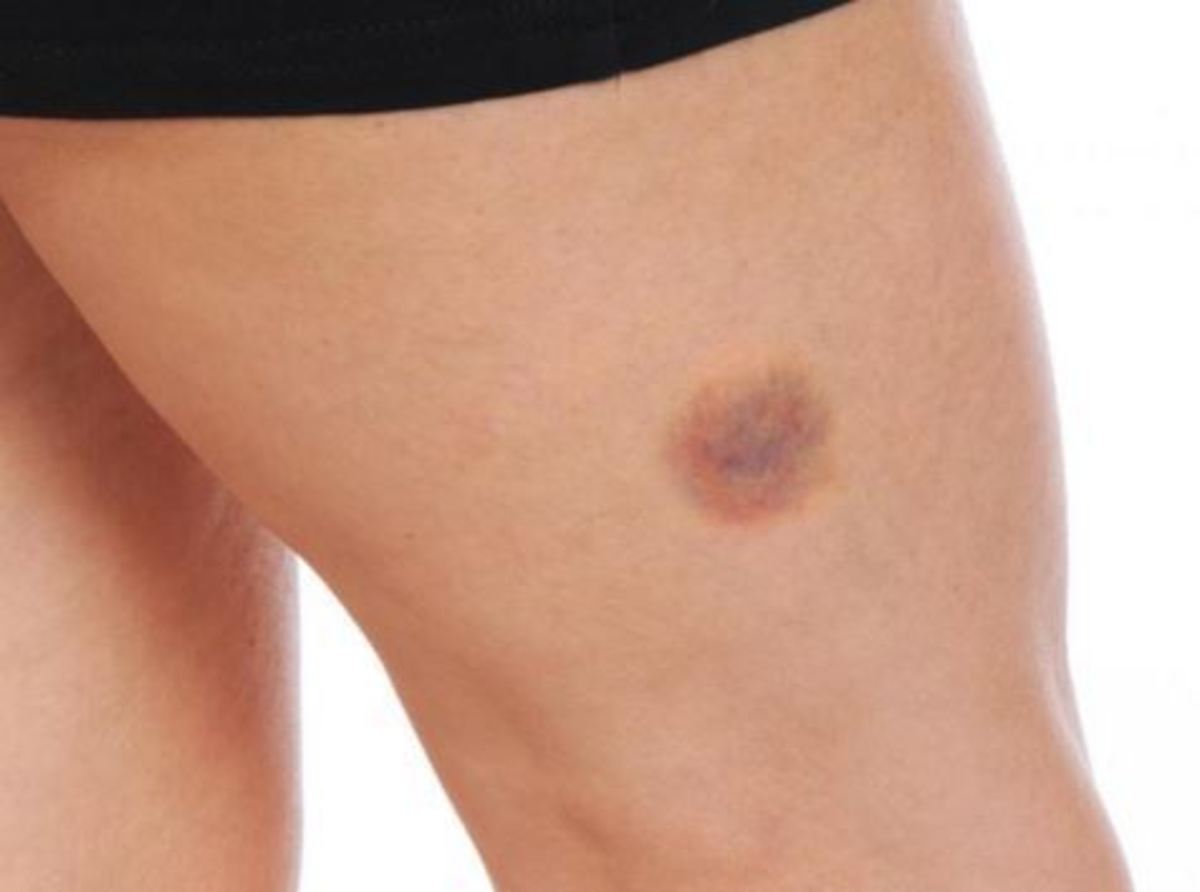 Τι συμβαίνει όταν βγάζετε μελανιές χωρίς προφανή αιτία