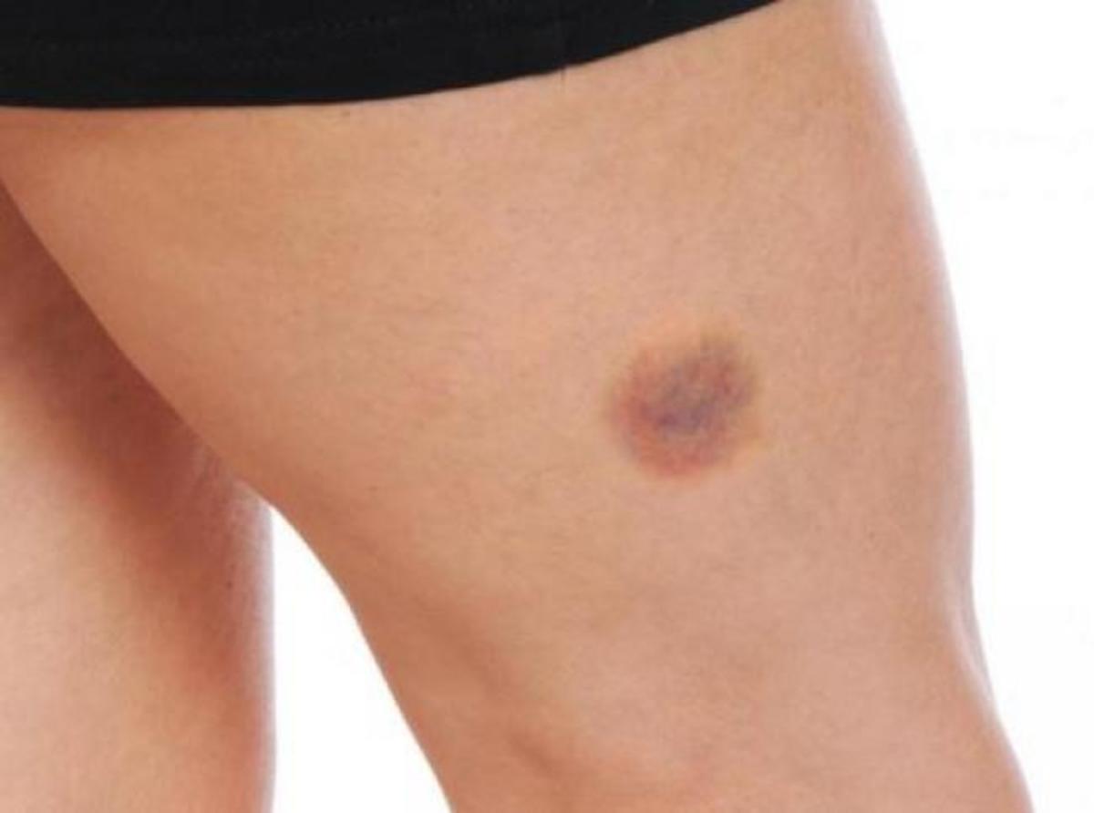 Γιατί κάνετε μελανιές χωρίς λόγο – ΠΡΟΣΟΧΗ στα πιθανά αίτια