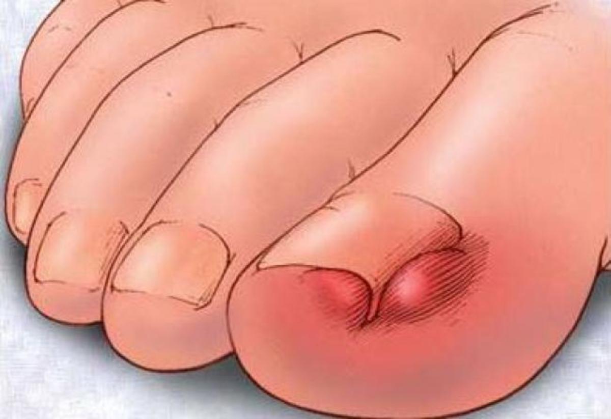 Νύχι που μπαίνει στο δέρμα: Τι μπορείτε να κάνετε στο σπίτι