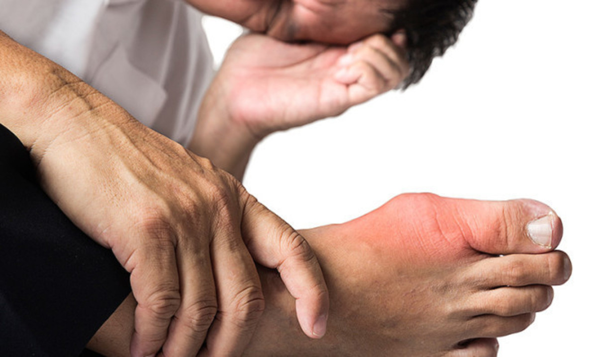 Ουρικό οξύ: Αν έχετε αυτά, κάντε εξετάσεις!