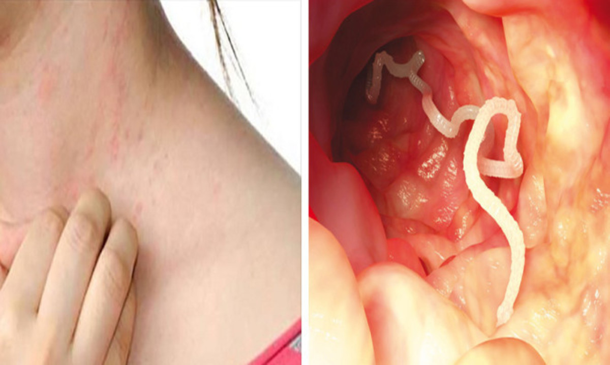 Προσοχή: Αν νιώσετε αυτά, μπορεί να έχετε παράσιτα στο στομάχι