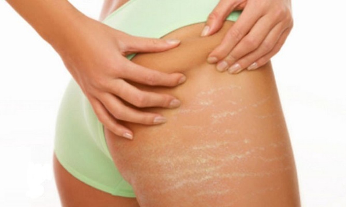 Έτσι θα εξαφανίσετε τις παλιές ραγάδες από το σώμα σας