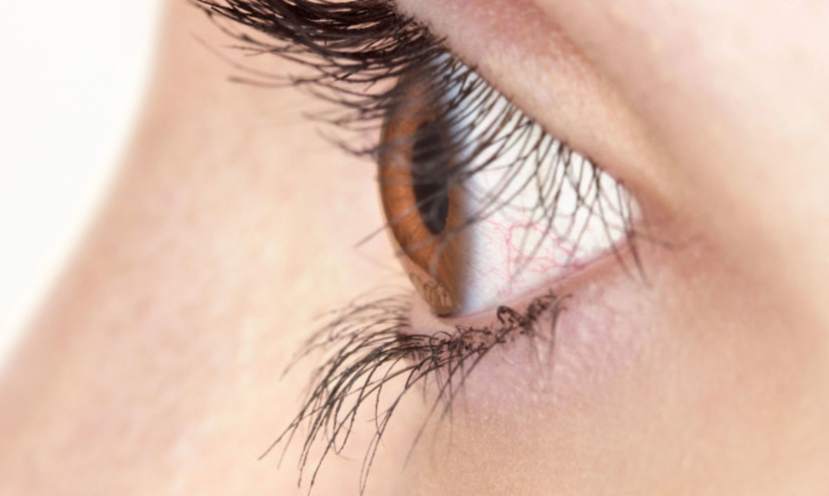 Χαλάζιο στο μάτι: Πώς φεύγει και γιατί δημιουργείται