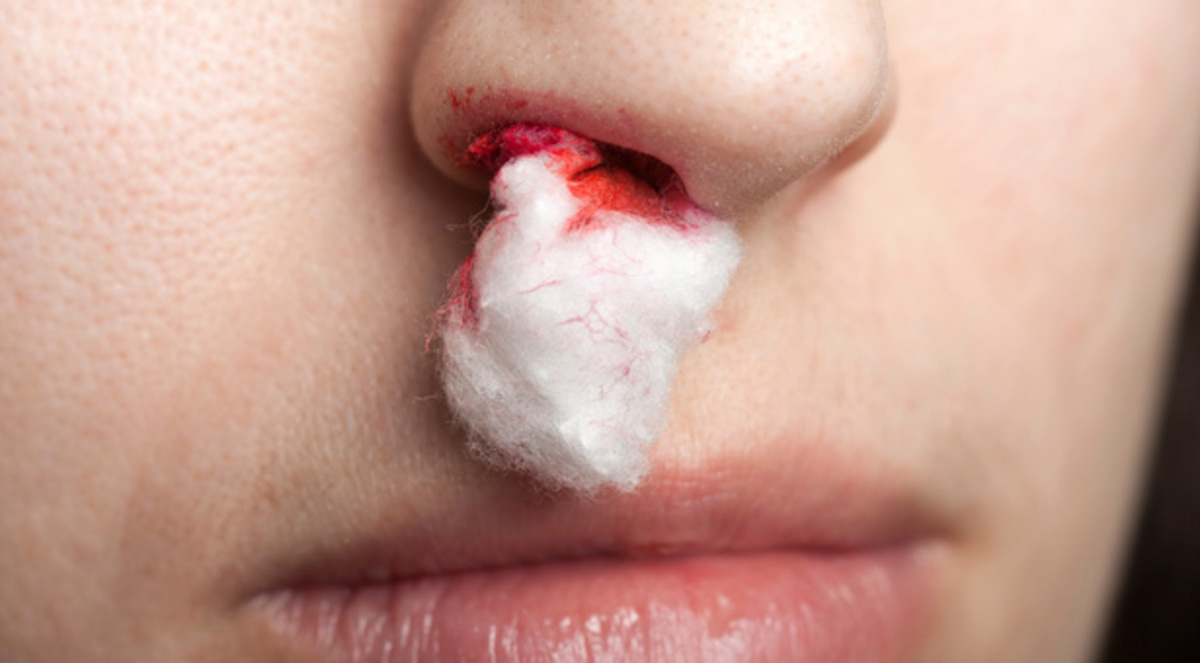 Αίμα από την μύτη: Τα λάθη που κάνετε και δεν το ξέρετε