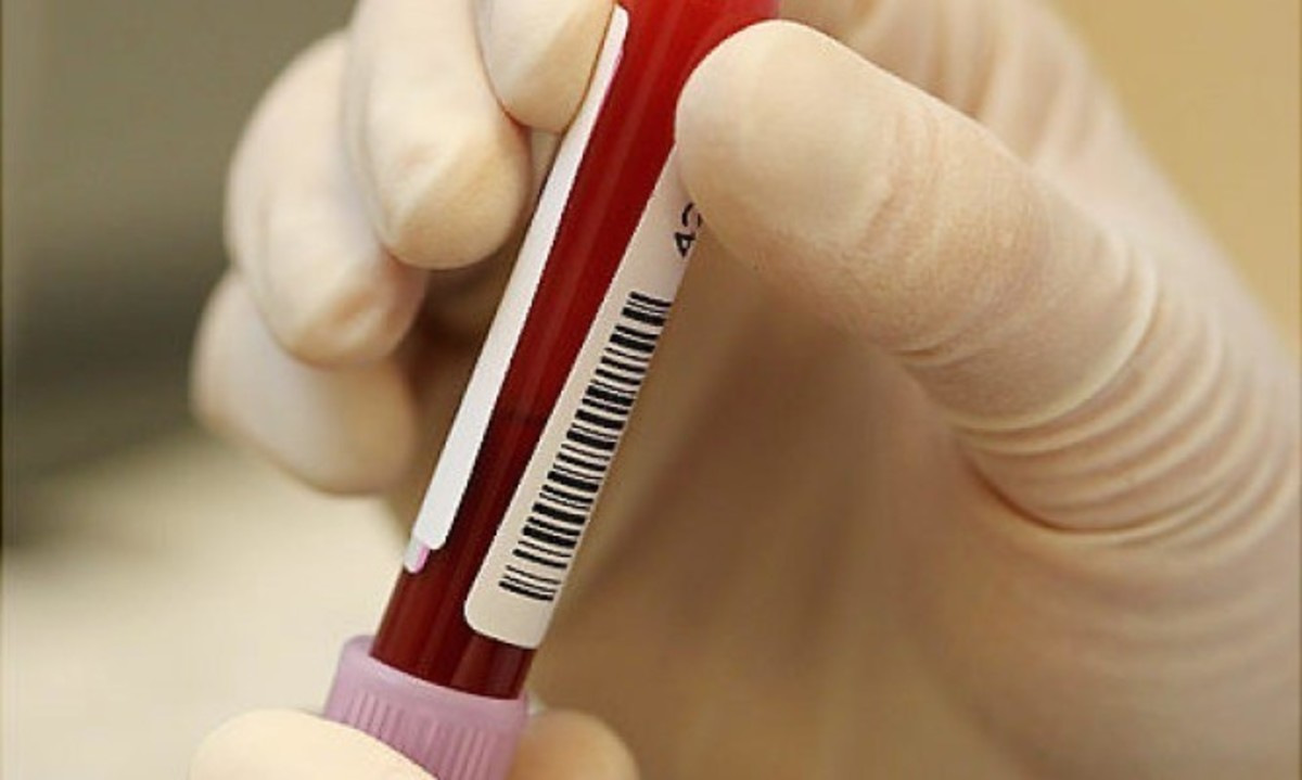 Προστατικό αντιγόνο: Τι πρέπει να γνωρίζει κάθε άντρας για τον έλεγχο του προστάτη