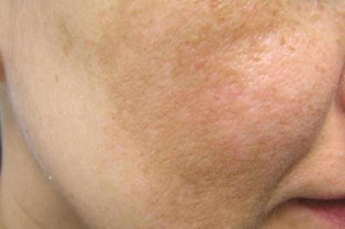 Πανάδες στο πρόσωπο: Τι να κάνετε για να τις περιορίσετε