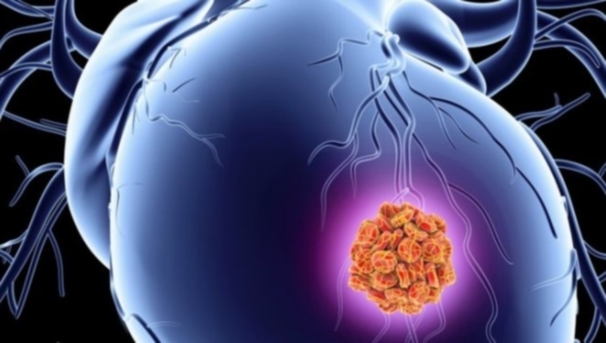 Ανακάλυψαν τσιρότο που σώζει μετά από έμφραγμα – Τι λένε οι επιστήμονες