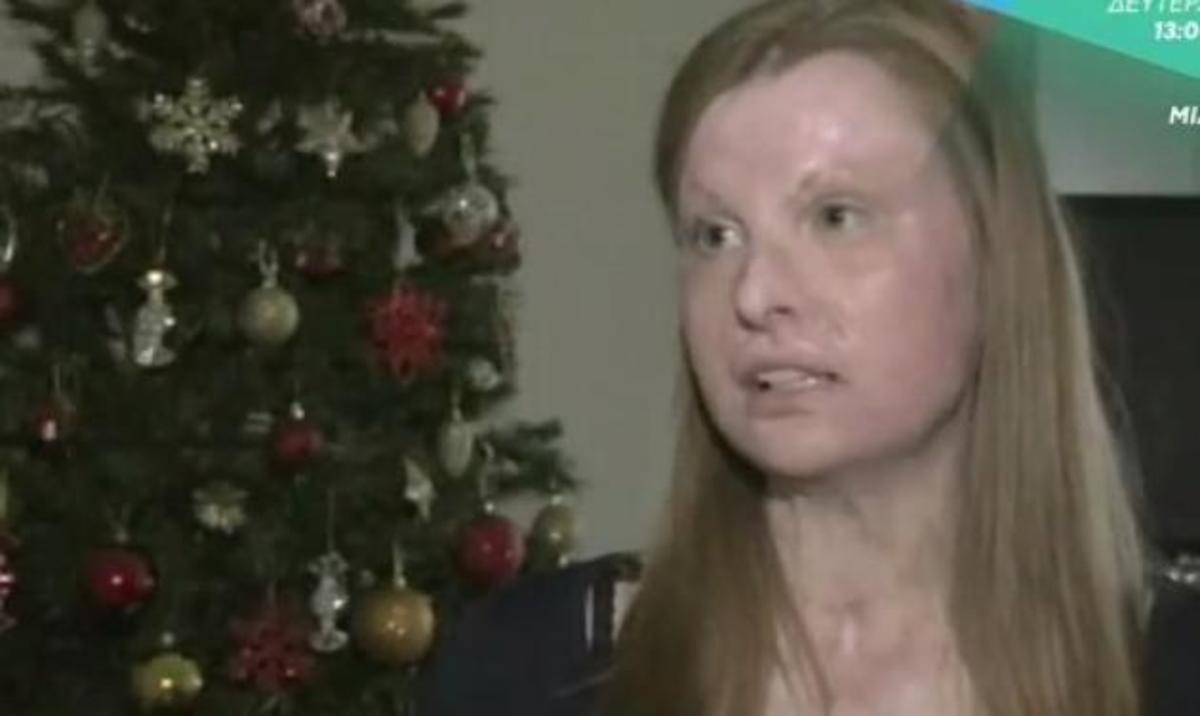 Η συγκλονιστική ιστορία της 18χρονης που παραμορφώθηκε από τη φωτιά!