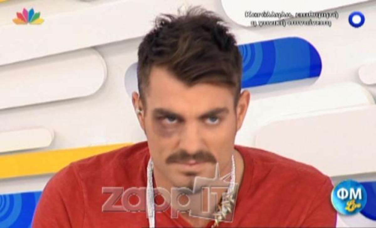 Με μαυρισμένο μάτι ο Στέλιος Χανταμπάκης
