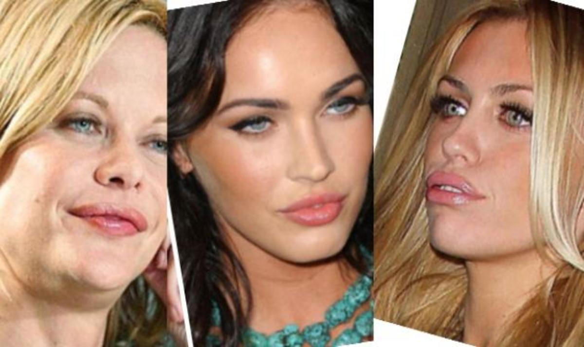 Γιατί οι star έχουν “κόλλημα” με τα φουσκωτά χείλη; Δες φωτογραφίες