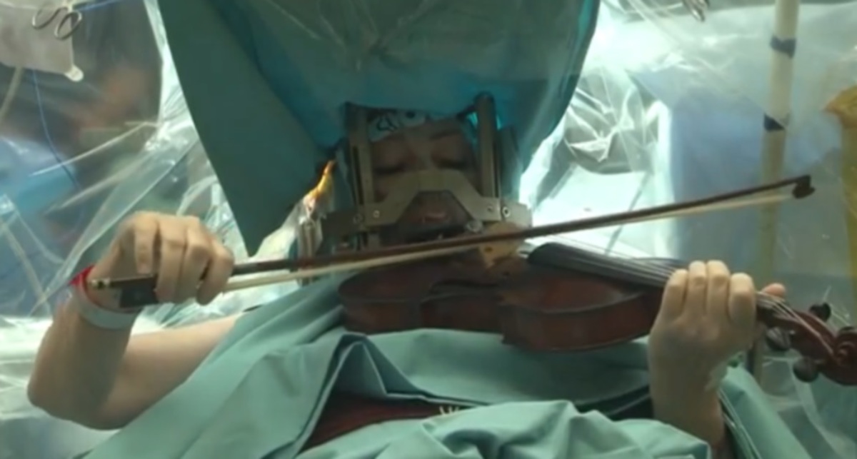 Tη χειρούργησαν στον εγκέφαλο ζωντανή και εκείνη έπαιζε βιολί – ΒΙΝΤΕΟ