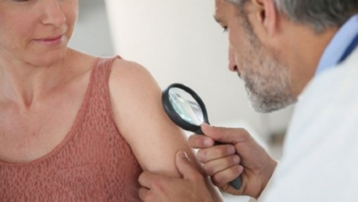 Πόσες ελιές (αριθμός) στο χέρι σας δείχνουν κίνδυνο καρκίνου του δέρματος, σύμφωνα με την επιστήμη