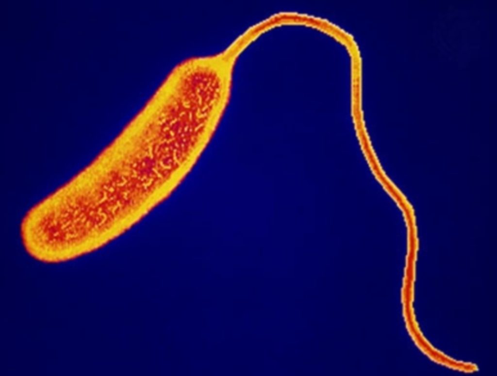 Παγκόσμια ημέρα φυματίωσης – Στοιχεία που σοκάρουν