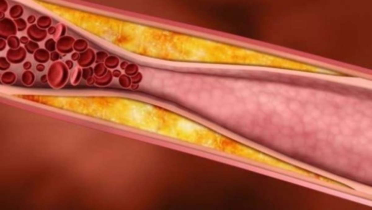 Στο μέλλον ένα εμβόλιο θα μας γλυτώνει από την υψηλή χοληστερίνη