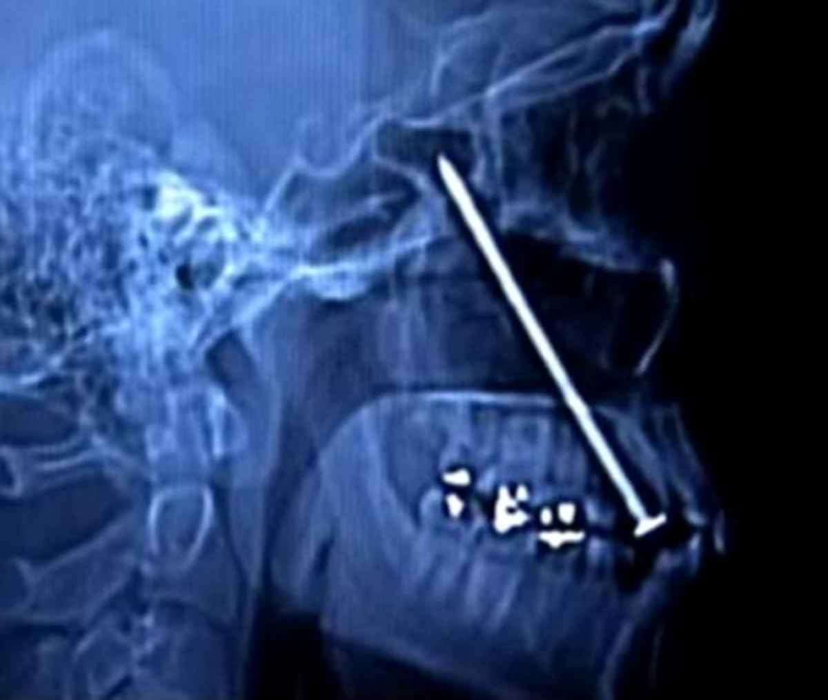 Γλίτωσε από το θάνατο για ένα χιλιοστό