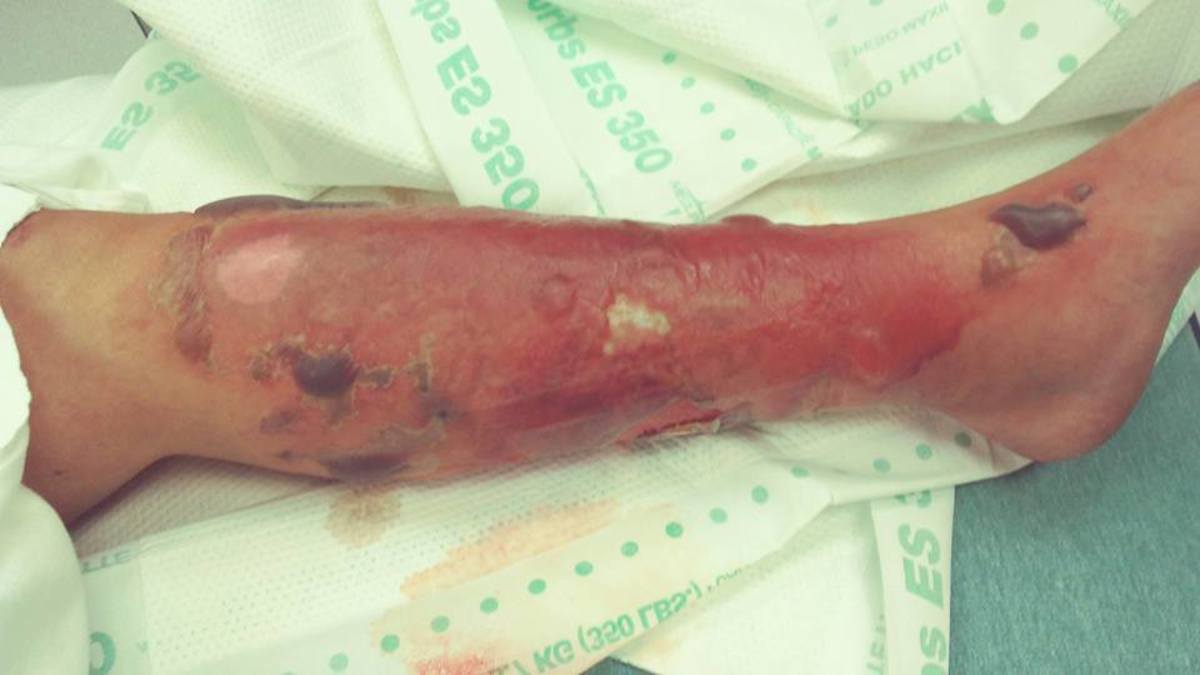 Χαμός στο Facebook: Γυναίκα λέει ότι μολύνθηκε με σαρκοφάγο βακτήριο σε παραλία! [vids]