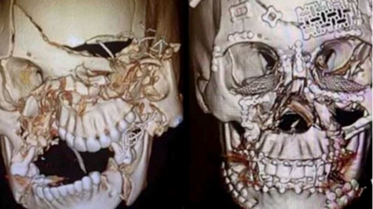 ΠΑΝΤΑ ΖΩΝΗ στο αμάξι! Σοκάρει το διαδίκτυο μια απίστευτη αναδόμηση κρανίου μετά από τρακάρισμα [pics]