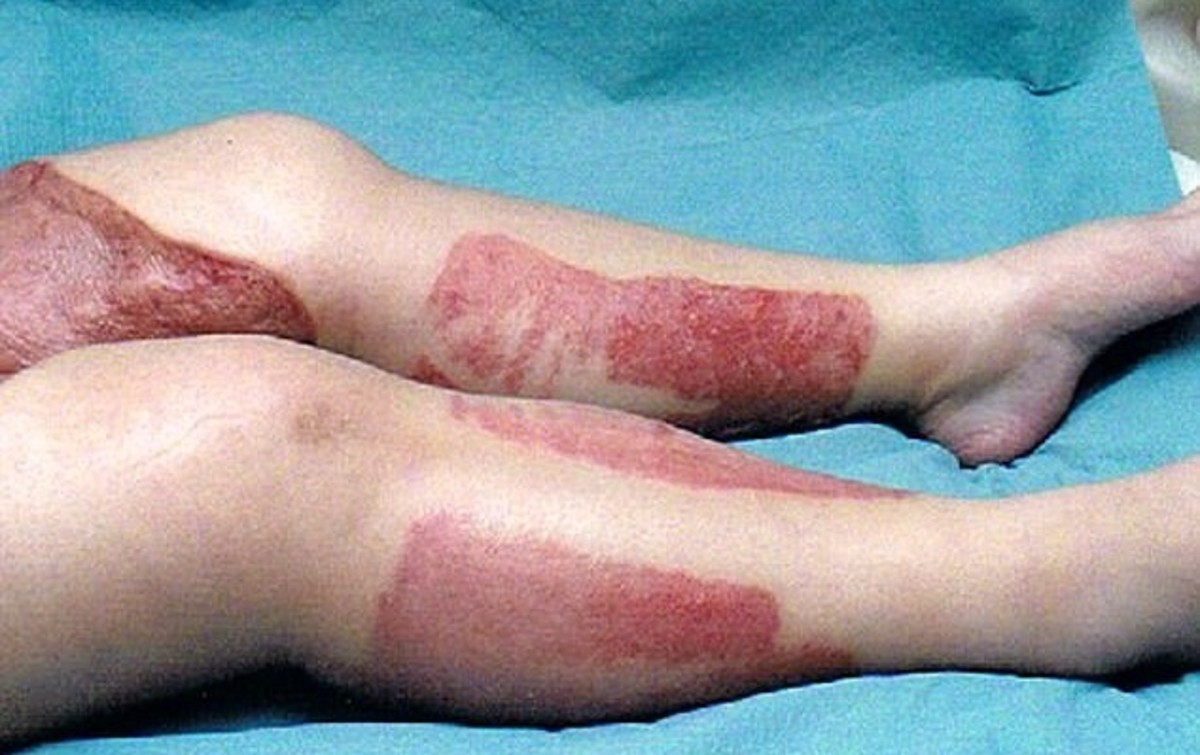 Έπαθε νεκρωτική φλεγμονή από ξύρισμα στο “μπικίνι” – Δείτε πως έγινε! [pics]