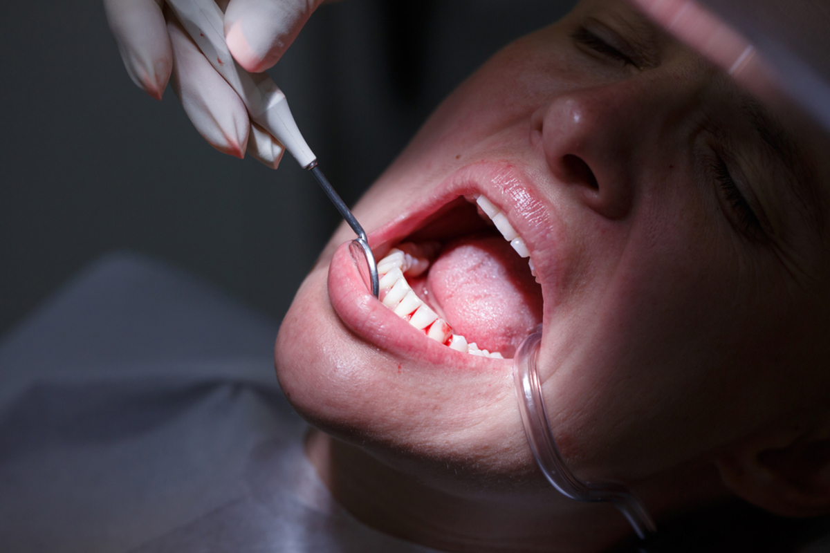 Καρκίνος: Πιο πιθανός για κάποια άτομα με πρόβλημα στα… δόντια – Τι διευκρινίζουν οι επιστήμονες