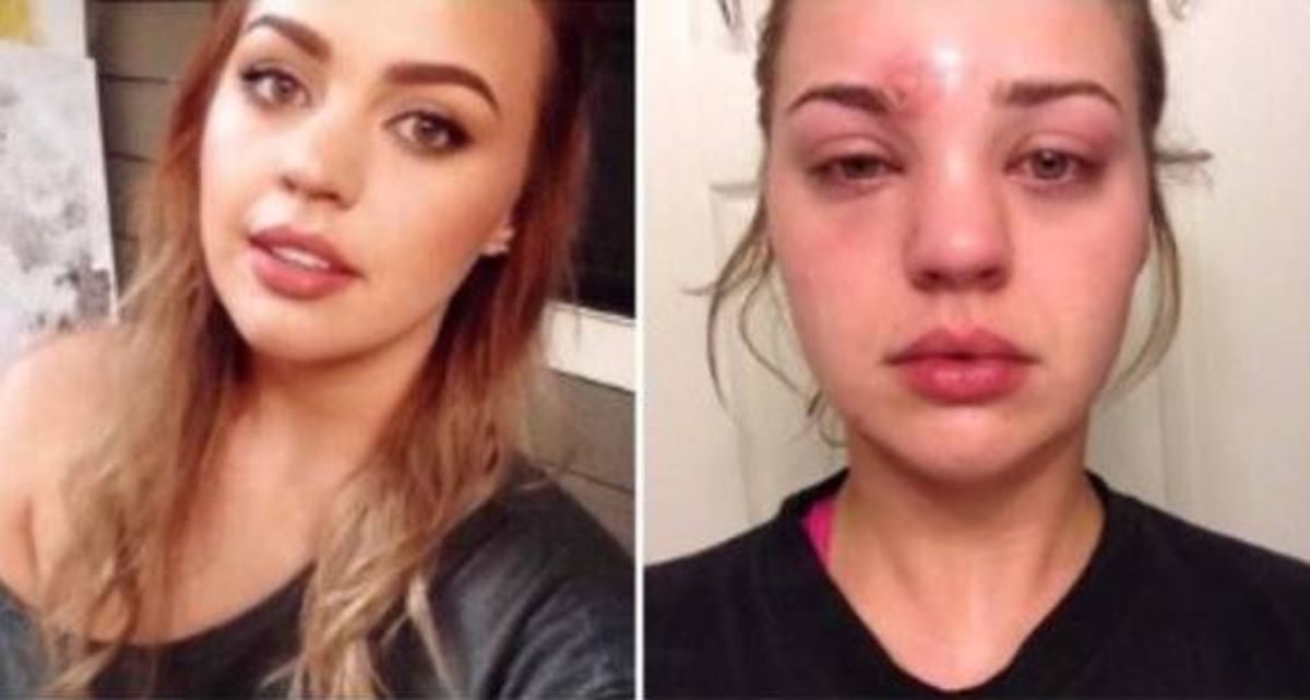 Δεν ήταν σπυράκι, αλλά σταφυλόκοκκος και παραλίγο να τυφλωθεί! – Δείτε ΟΛΑ τα συμπτώματα [pics]