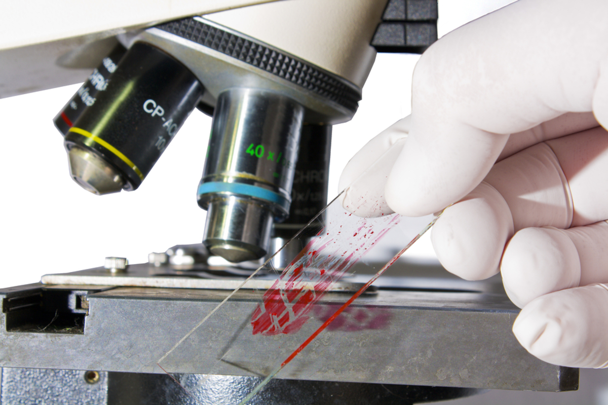 Καρκίνος: Μεγάλες ελπίδες από νέο τεστ αίματος που τον εντοπίζει πολύ αποτελεσματικά