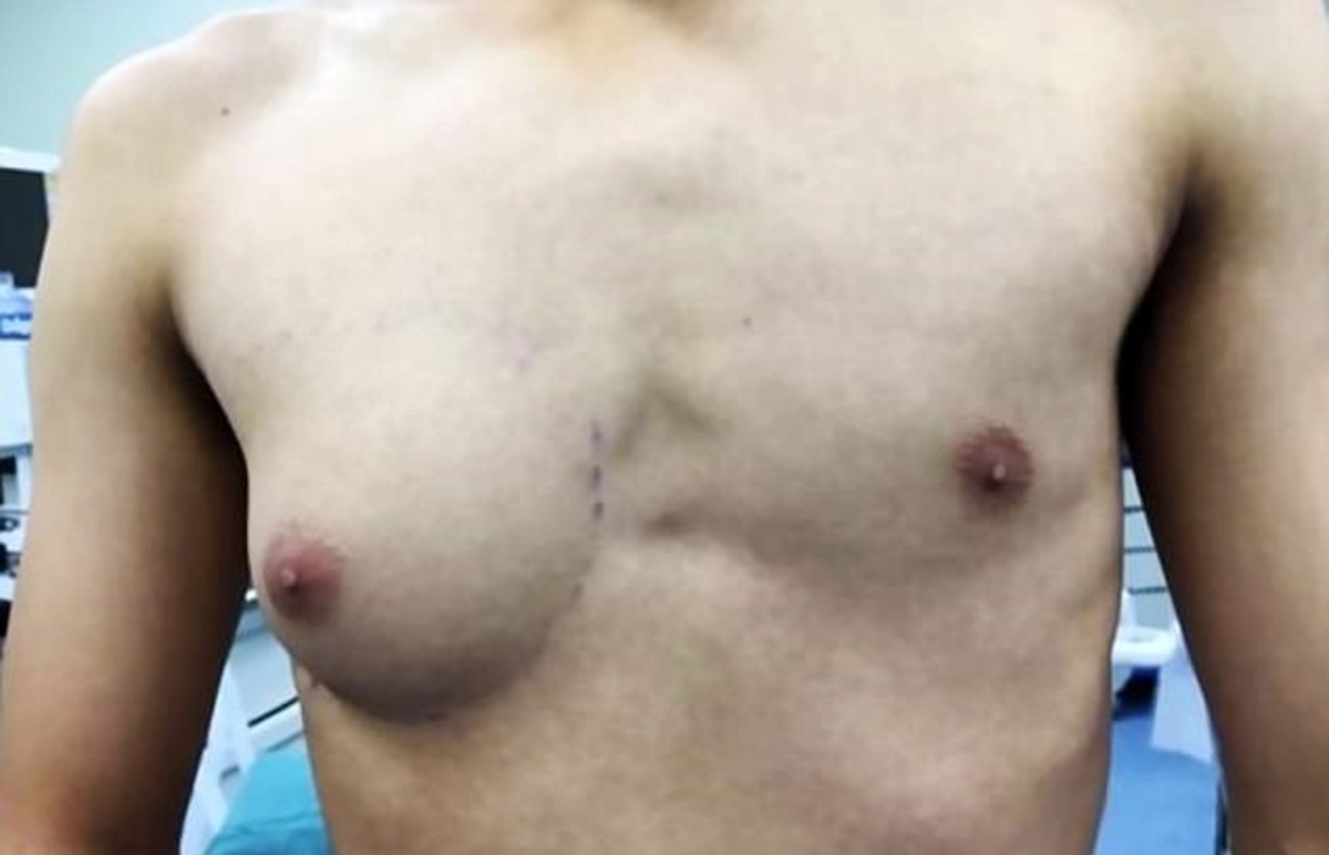 Γυναικομαστία σε άντρες εξαιτίας των fast food – Δείτε τι έπαθε ένας 19χρονος! [pics]