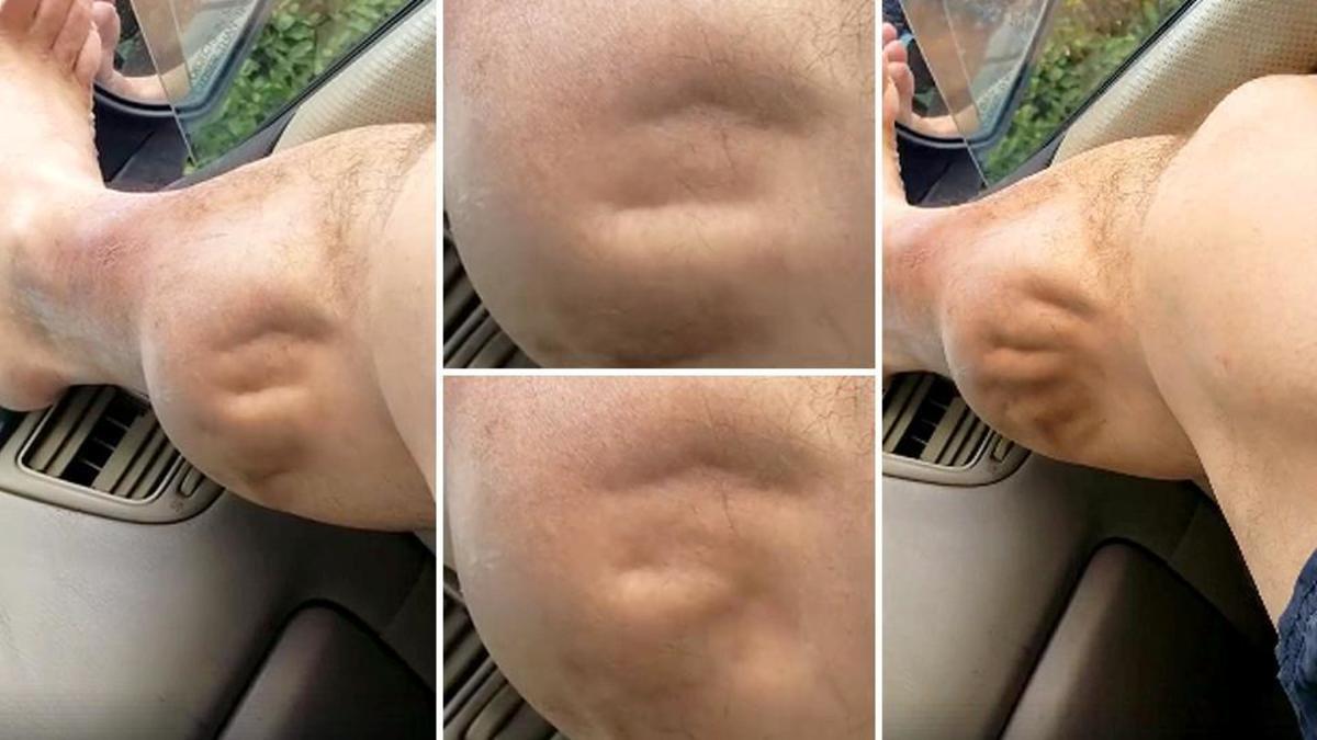 Η… εξωγήινη κράμπα που έγινε viral – Δείτε πώς γίνεται το πόδι του! [vid]