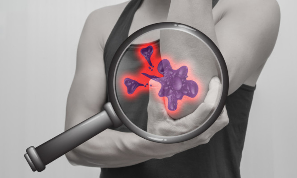 Πολλαπλό μυέλωμα – Συμπτώματα: Ο ύπουλος καρκίνος που “τρώει” τα οστά [vid]