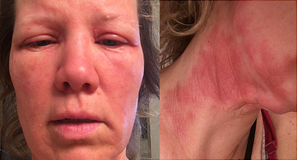 Αιθέρια έλαια: Το φυσικό δεν σημαίνει και ακίνδυνο – Δείτε τι έπαθε! [vid, pic]