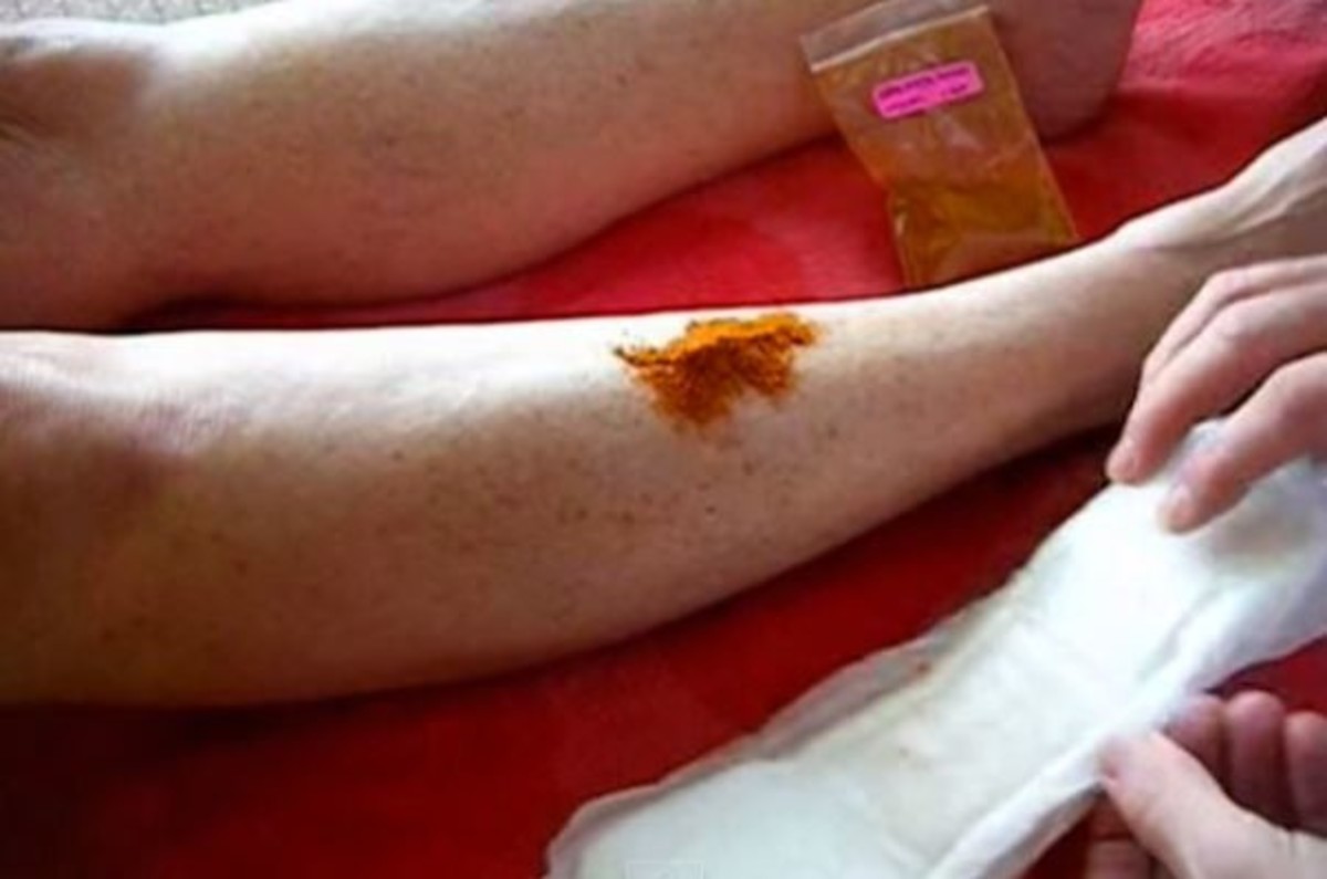 Αιμορραγία από απλό κόψιμο στο δέρμα: Δείτε ποιο μπαχαρικό (!) την σταματάει