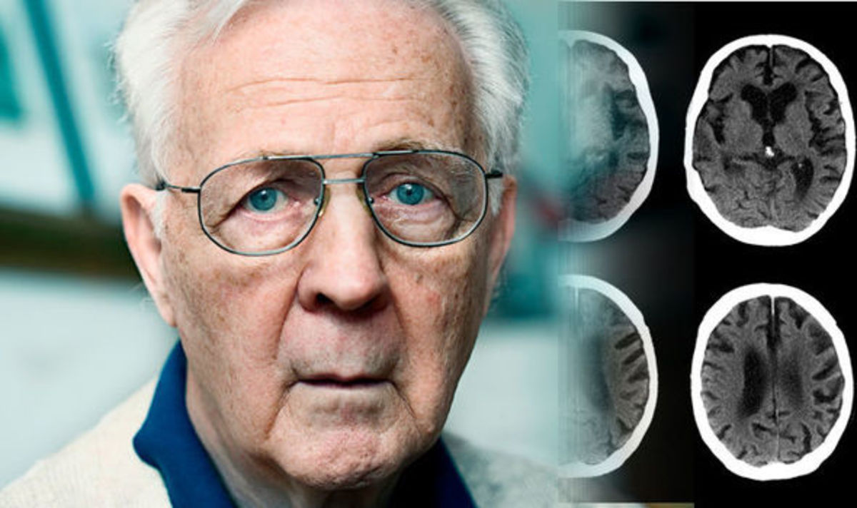Αλτσχάιμερ: Η απώλεια αυτής την ικανότητας μπορεί να είναι σοβαρό σύμπτωμα άνοιας