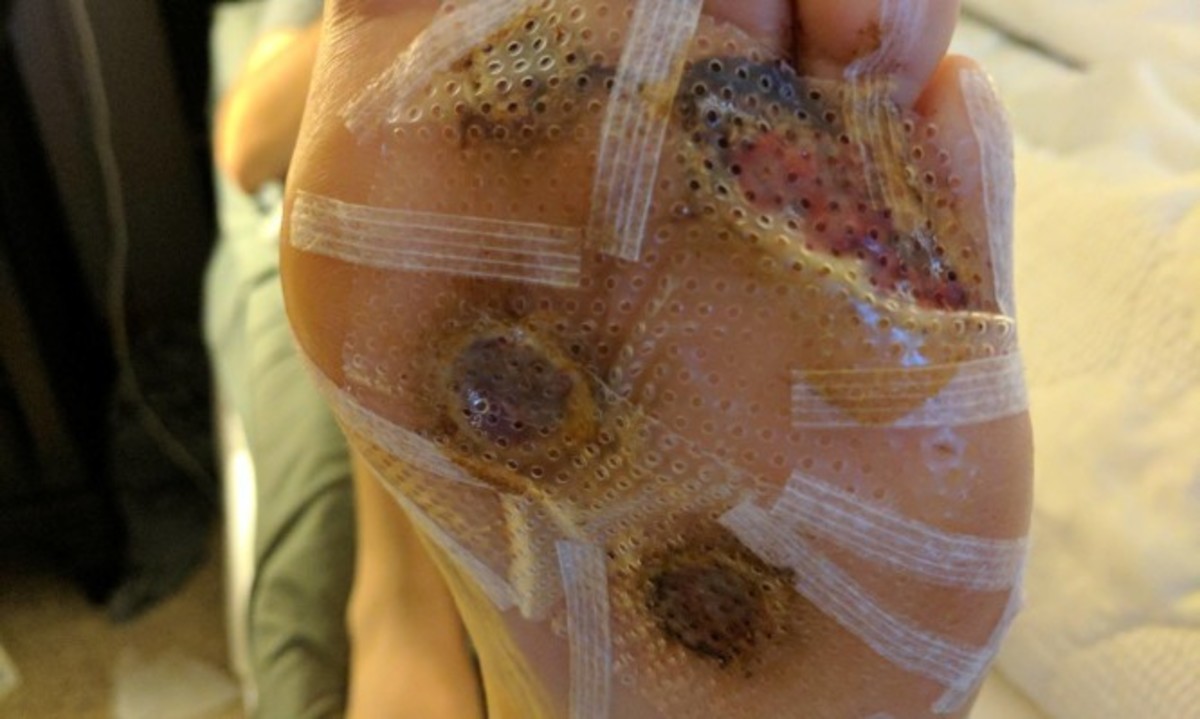 Έπαθε ΑΥΤΟ επειδή έμεινε ξυπόλυτος στο γυμναστήριο – Από τι μολύνθηκε [pics]