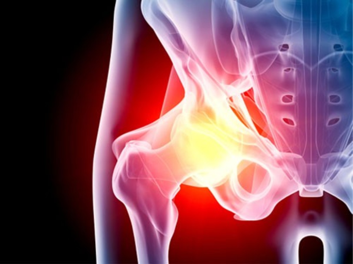 AMIS: 9 απαντήσεις για την πιο ελάχιστα επεμβατική αρθροπλαστική ισχίου