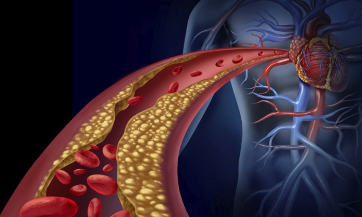 Καλά νέα για το έμφραγμα και την αθηροσκλήρυνση