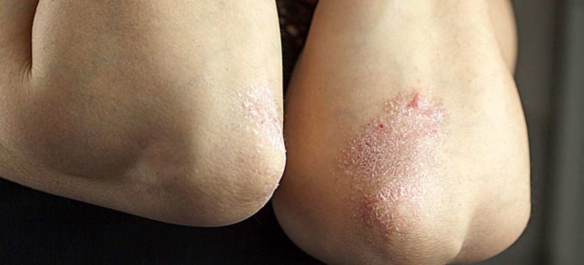 Ψωρίαση: Περισσότεροι από τους μισούς ασθενείς δεν επιτυγχάνουν καθαρό δέρμα